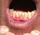 pemphigus vulgaris