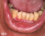 pemphigus vulgaris