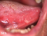 pemphigus vulgaris