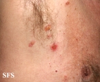 pemphigus vulgaris