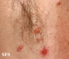 pemphigus vulgaris
