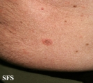 pemphigus vulgaris