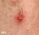 pemphigus vulgaris