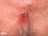 pemphigus vulgaris
