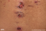 pemphigus vulgaris