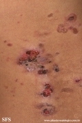 pemphigus vulgaris