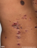 pemphigus vulgaris