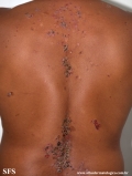 pemphigus vulgaris