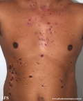 pemphigus vulgaris