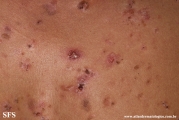 pemphigus vulgaris