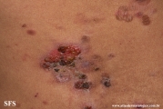 pemphigus vulgaris