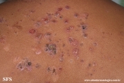 pemphigus vulgaris