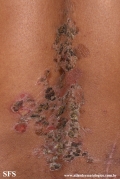 pemphigus vulgaris