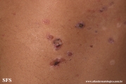 pemphigus vulgaris