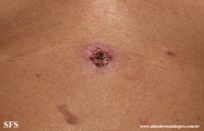 pemphigus vulgaris