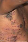 pemphigus vulgaris