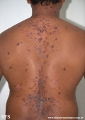 pemphigus vulgaris