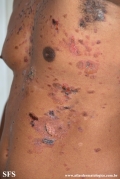 pemphigus vulgaris