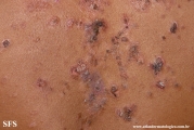 pemphigus vulgaris