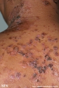 pemphigus vulgaris