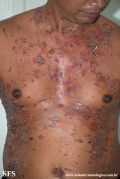 pemphigus vulgaris
