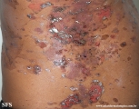 pemphigus vulgaris