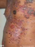 pemphigus vulgaris