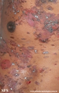 pemphigus vulgaris