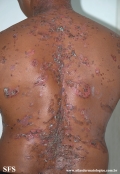 pemphigus vulgaris
