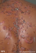 pemphigus vulgaris