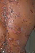 pemphigus vulgaris