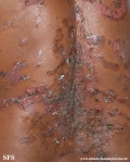 pemphigus vulgaris