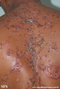 pemphigus vulgaris