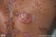 pemphigus vulgaris