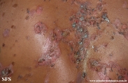 pemphigus vulgaris