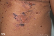 pemphigus vulgaris