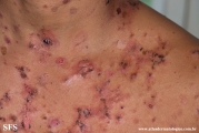pemphigus vulgaris
