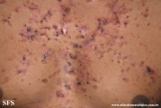 pemphigus vulgaris