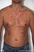 pemphigus vulgaris