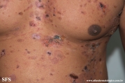 pemphigus vulgaris