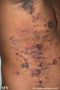 pemphigus vulgaris