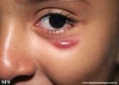 idiopathic_facial_aseptic_granuloma