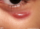 idiopathic_facial_aseptic_granuloma