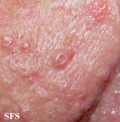 sebaceous gland hyperplasia