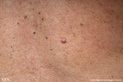myxoma-cutaneous_myxoma