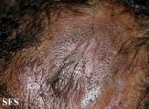 syringolymphoid hyperplasia with alopecia