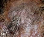 syringolymphoid hyperplasia with alopecia