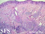 syringolymphoid hyperplasia with alopecia