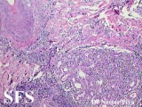 syringolymphoid hyperplasia with alopecia