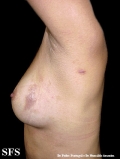 schistosomiasis-cutaneous
